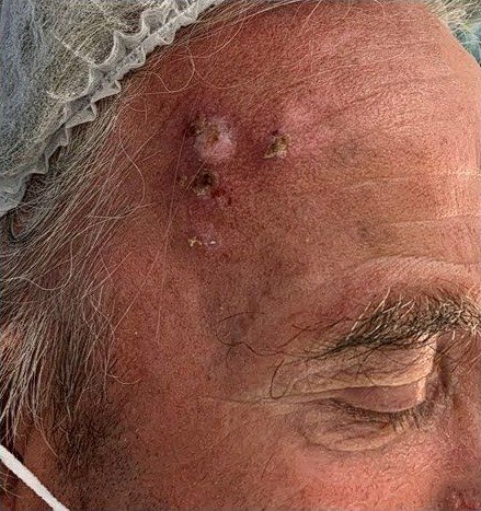 Antes del tratamiento: carcinoma espinocelular en la frente