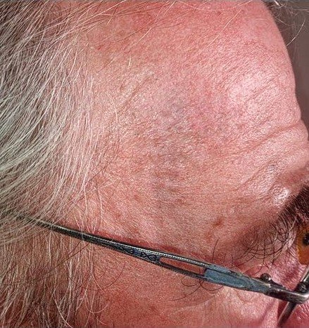 Después del tratamiento: la misma zona con la piel recuperada